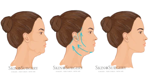 Classic facelift side view