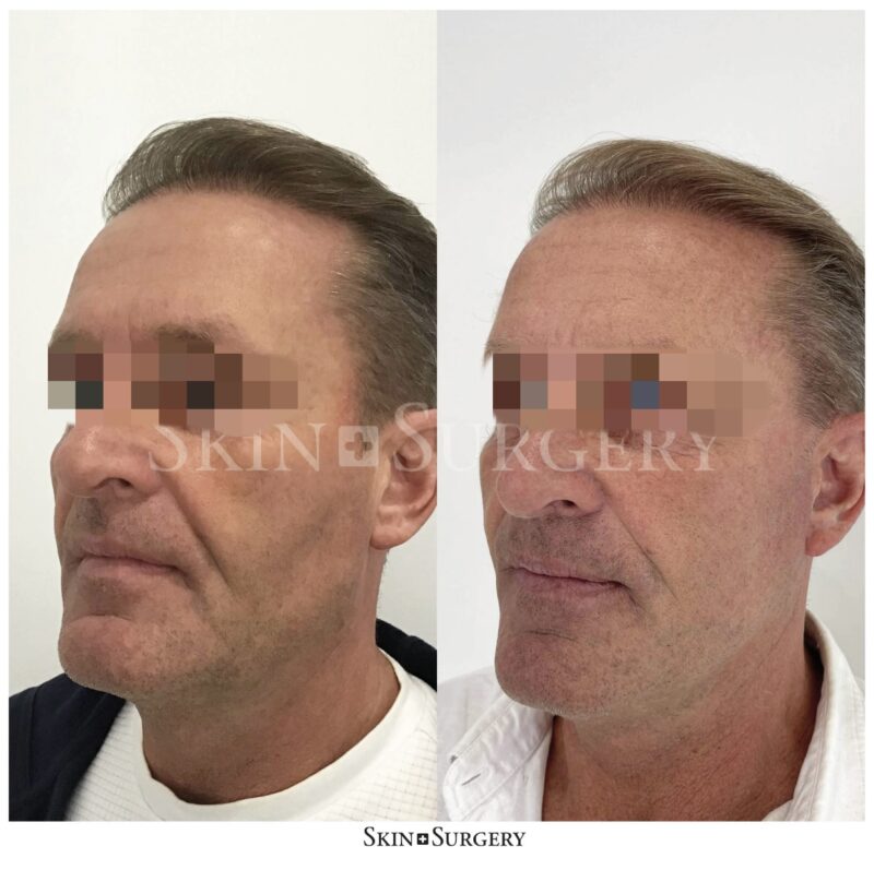 facelift buccal treatment final result
