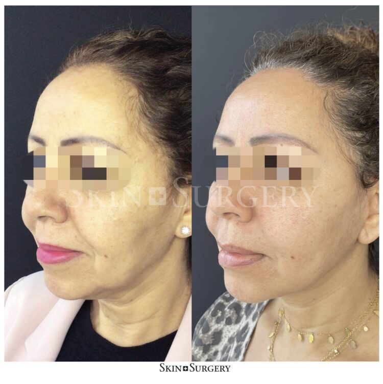 facelift consequence