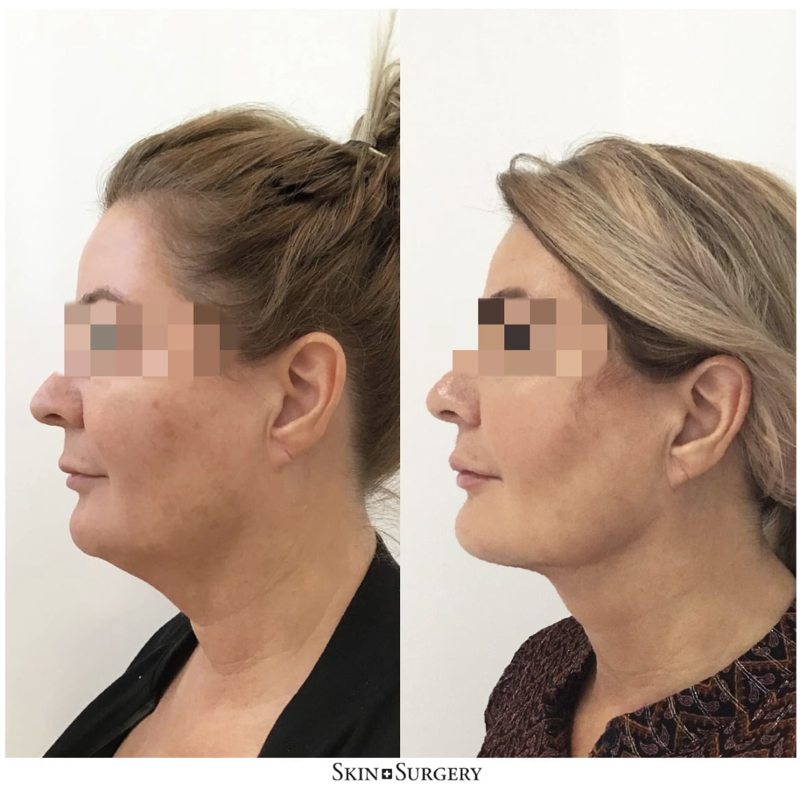 faceslimming end result