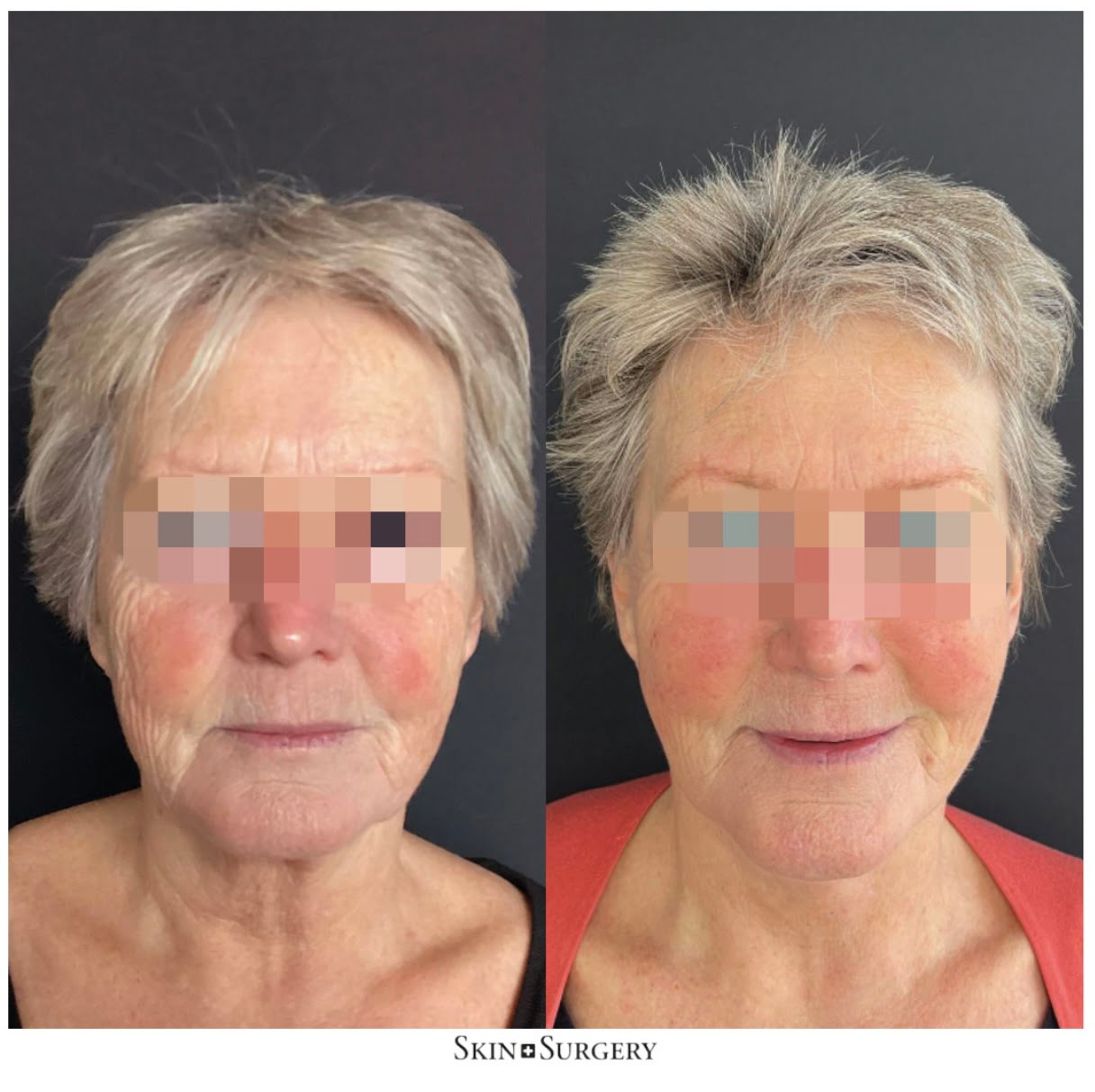 before and after face neck lift result