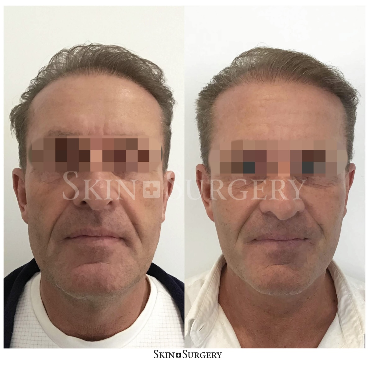 facelift treatment end result