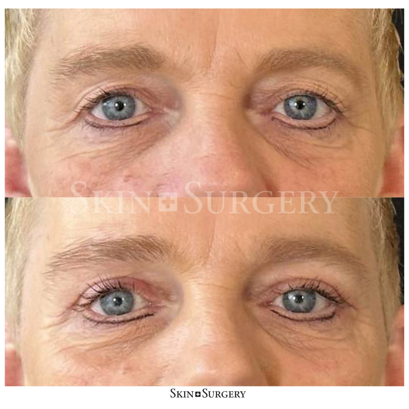 eyelid surgery outcome skin surgery