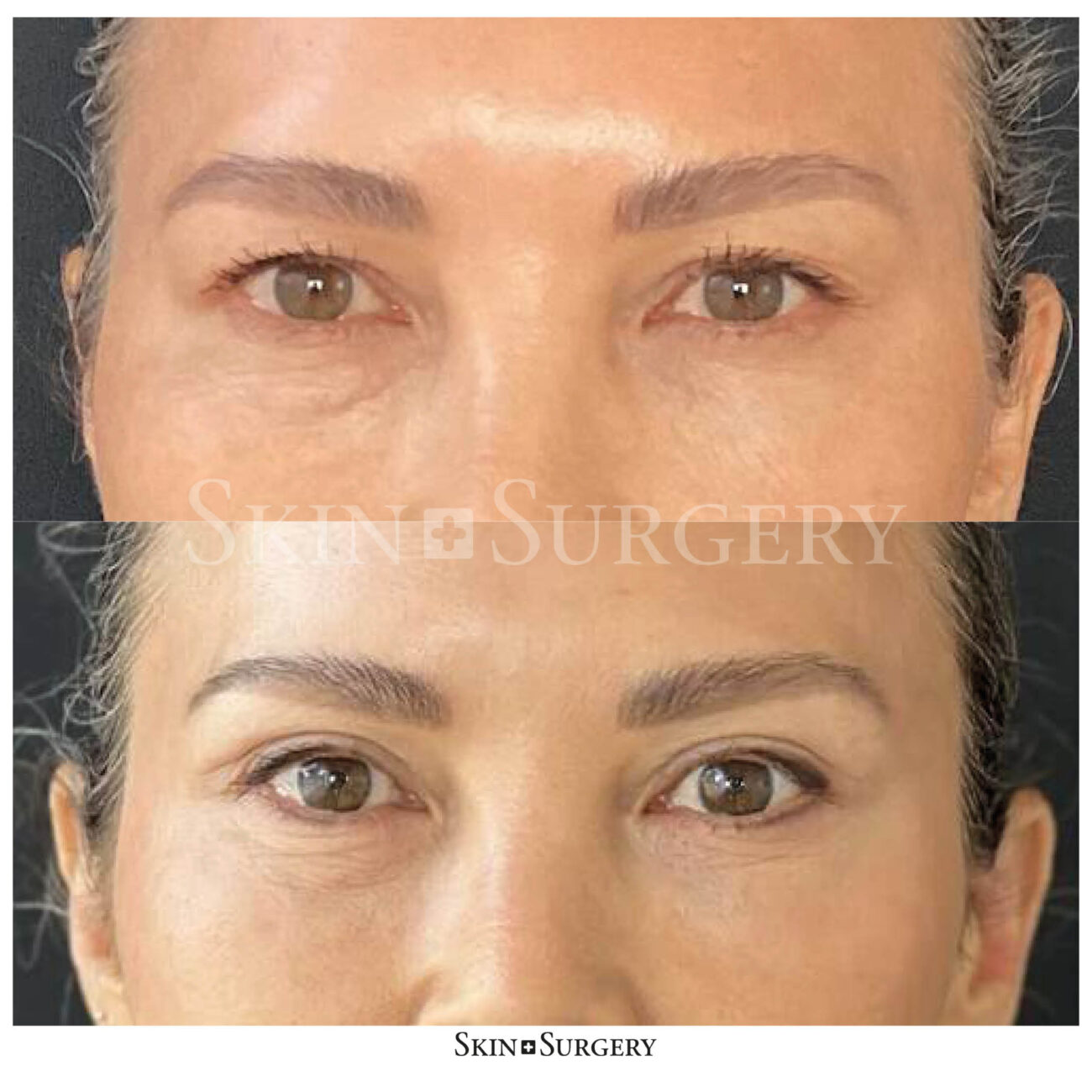 eyelid surgery before and after