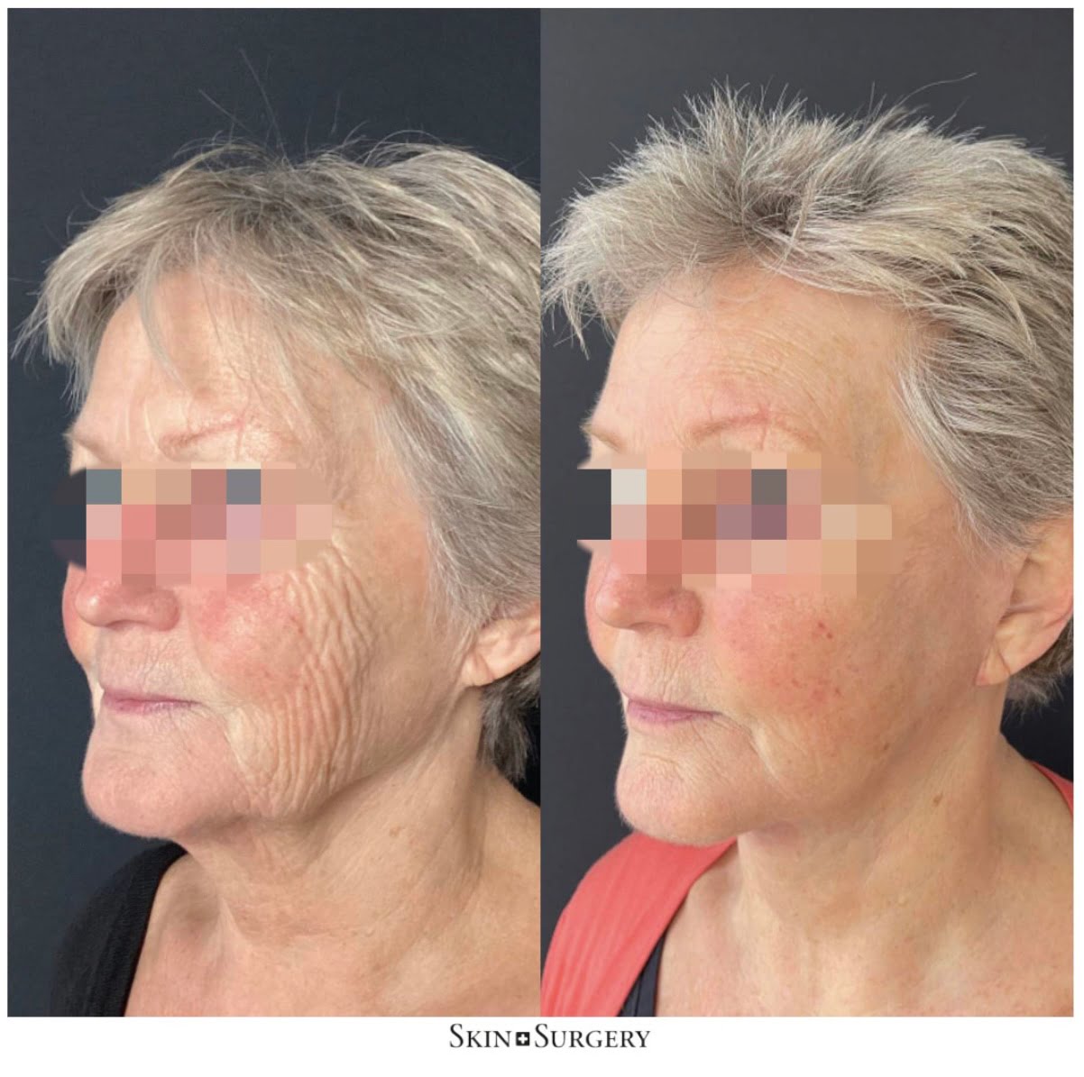 result after face neck lift