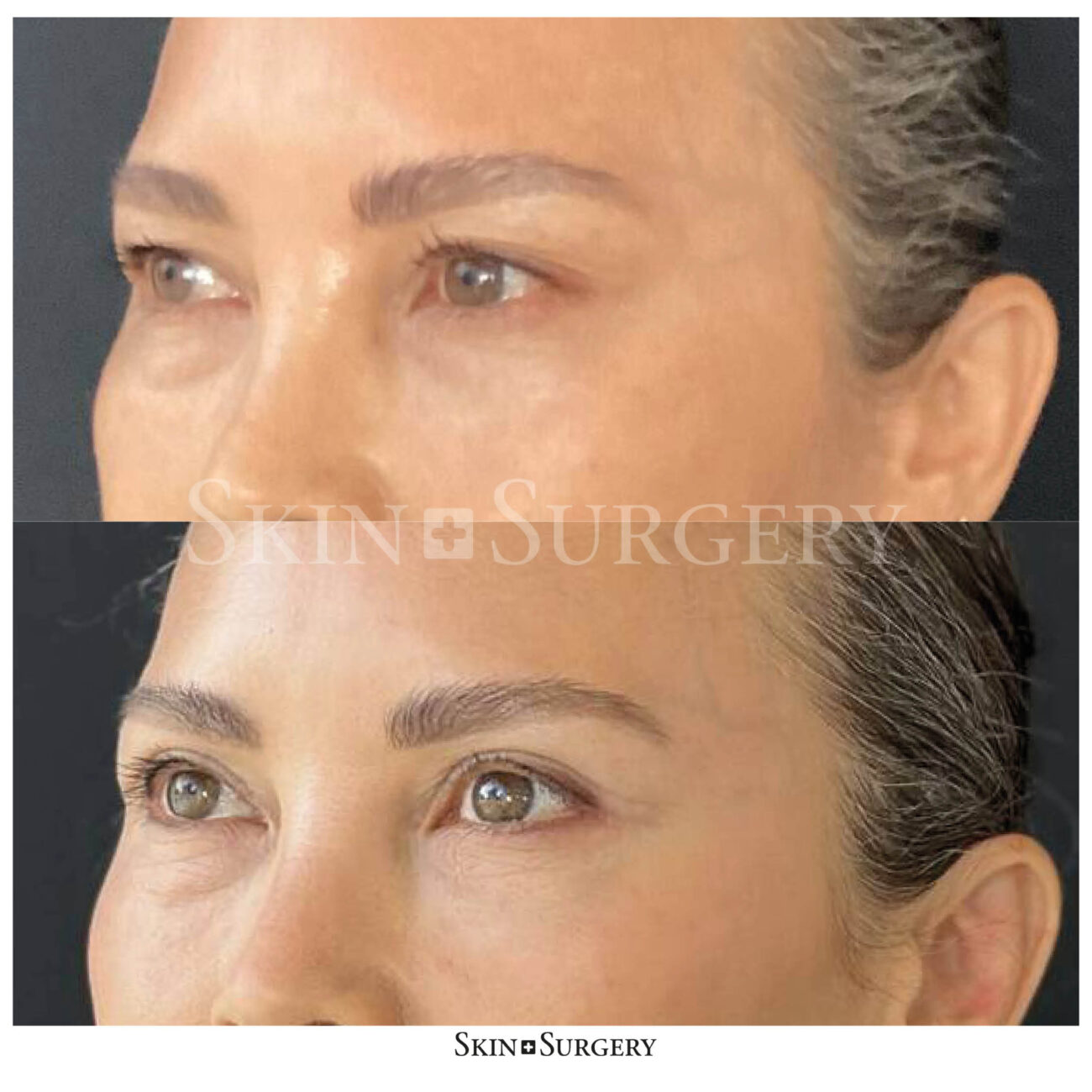result before and after eyelid surgery