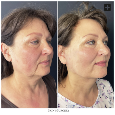 final result facelift