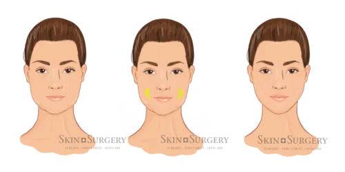 Buccal fat removal against hamster cheeks illustration