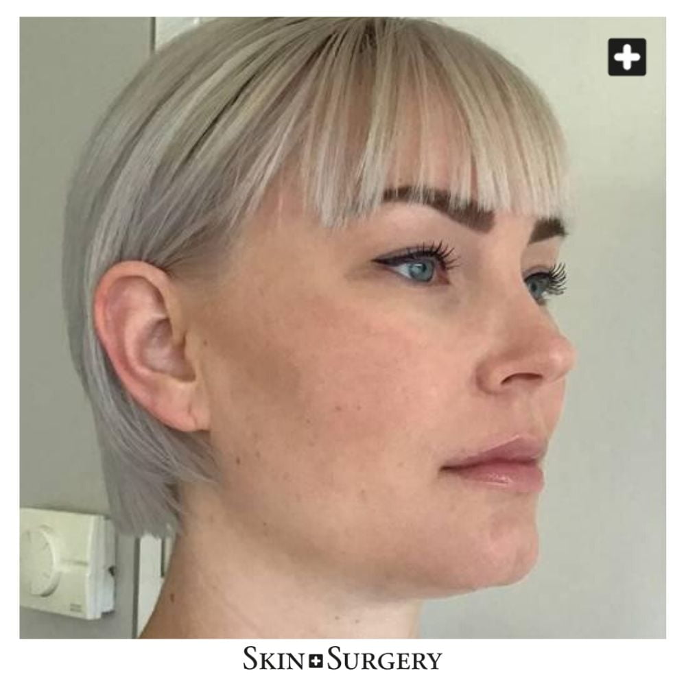 for buccal fat removal treatment