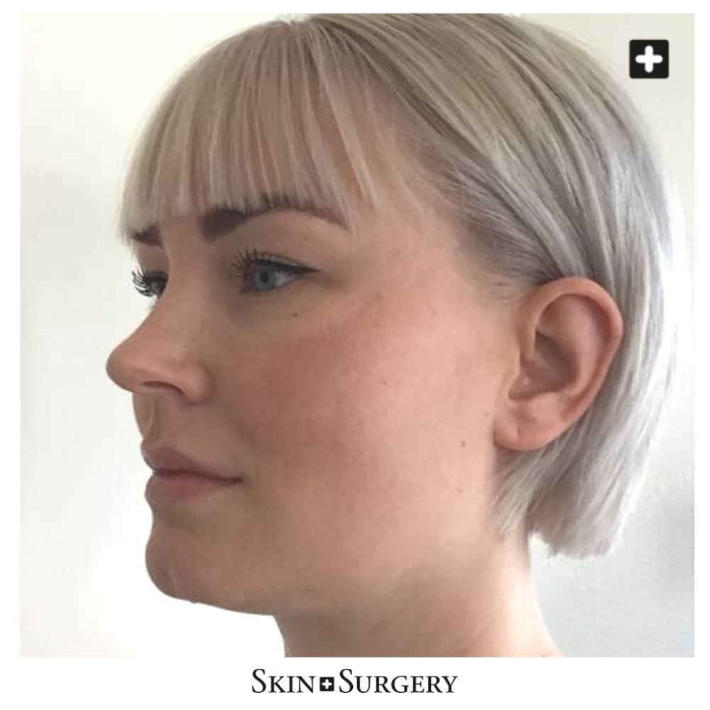 before buccal fat removal