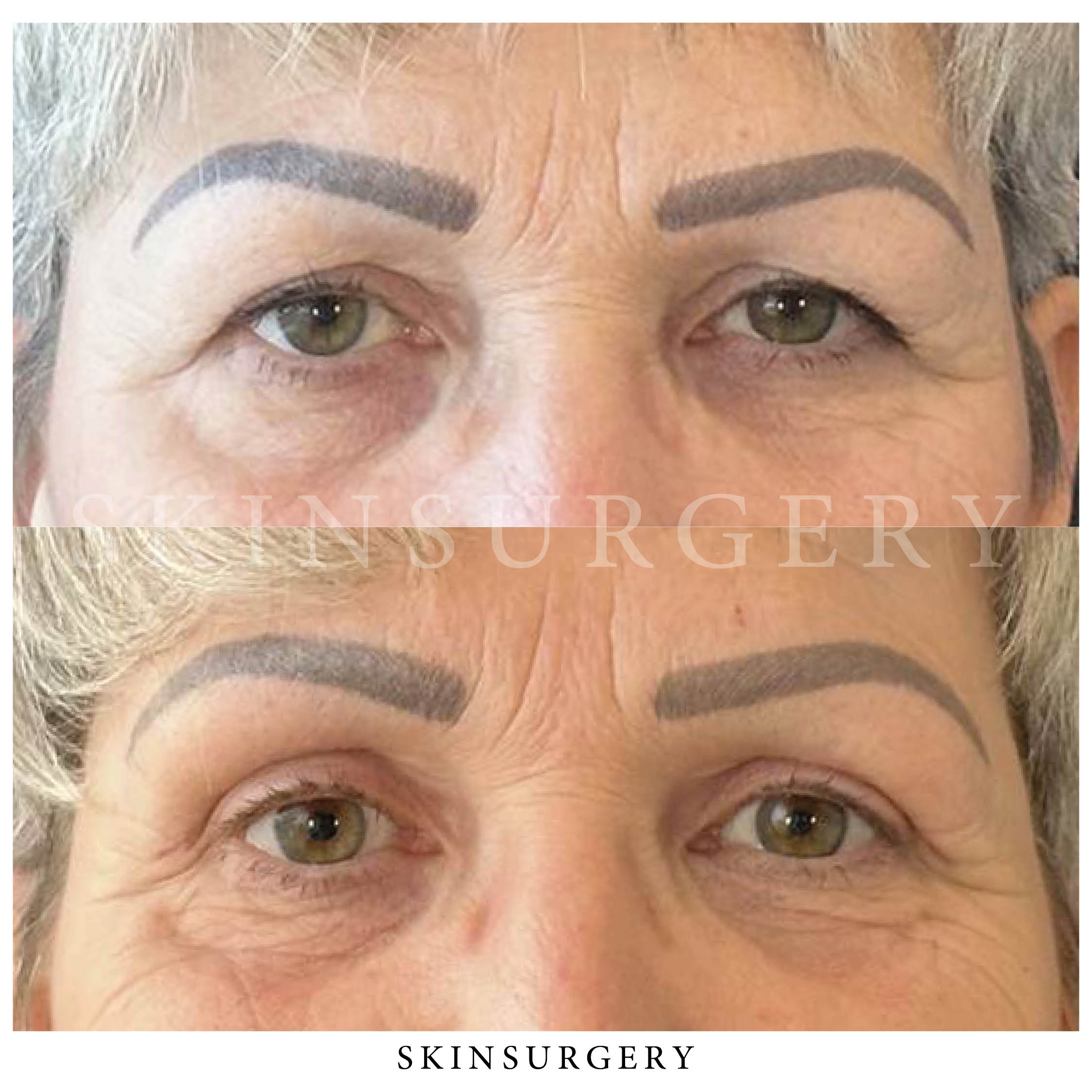 upper eyelid surgery outcome