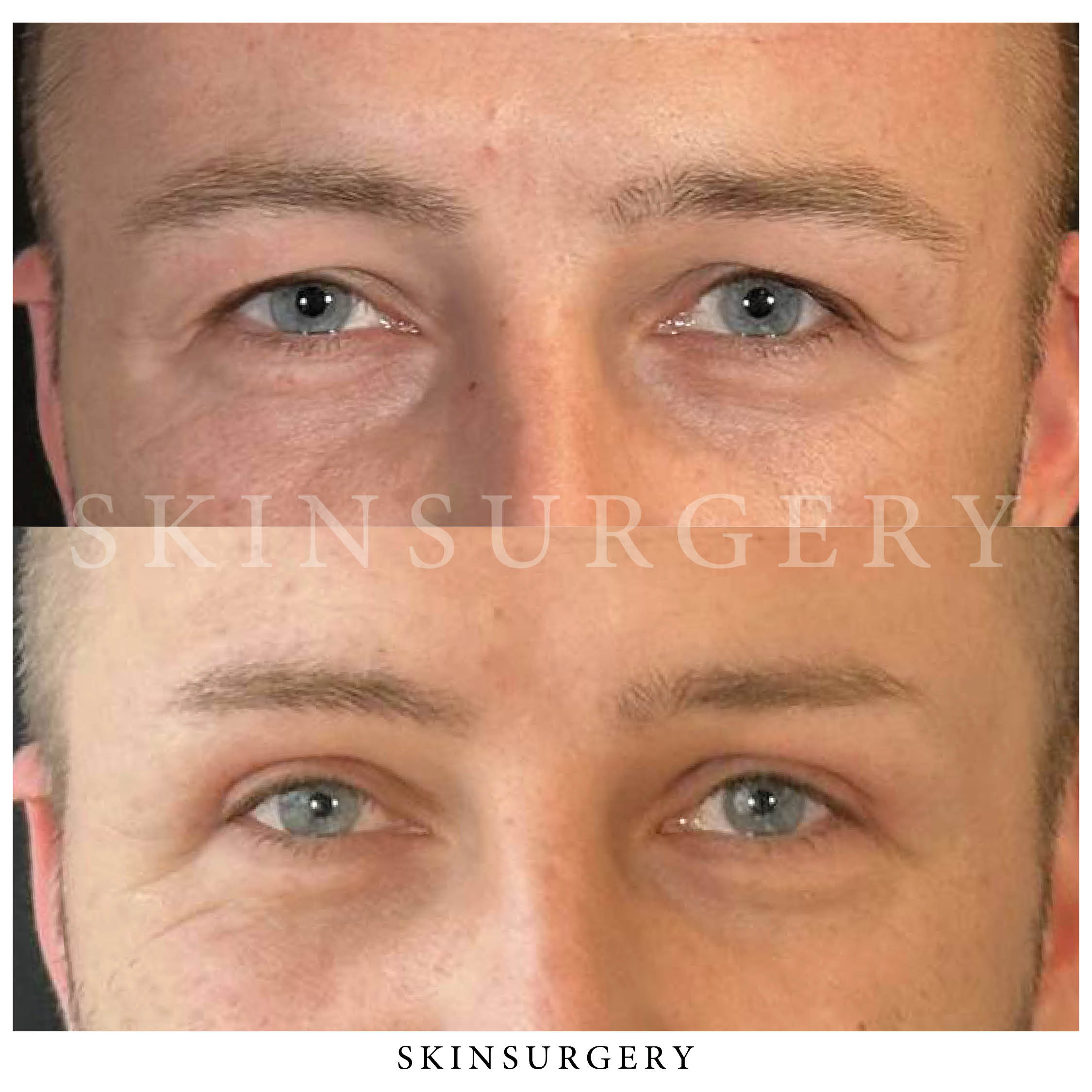 upper eyelid surgery final effect