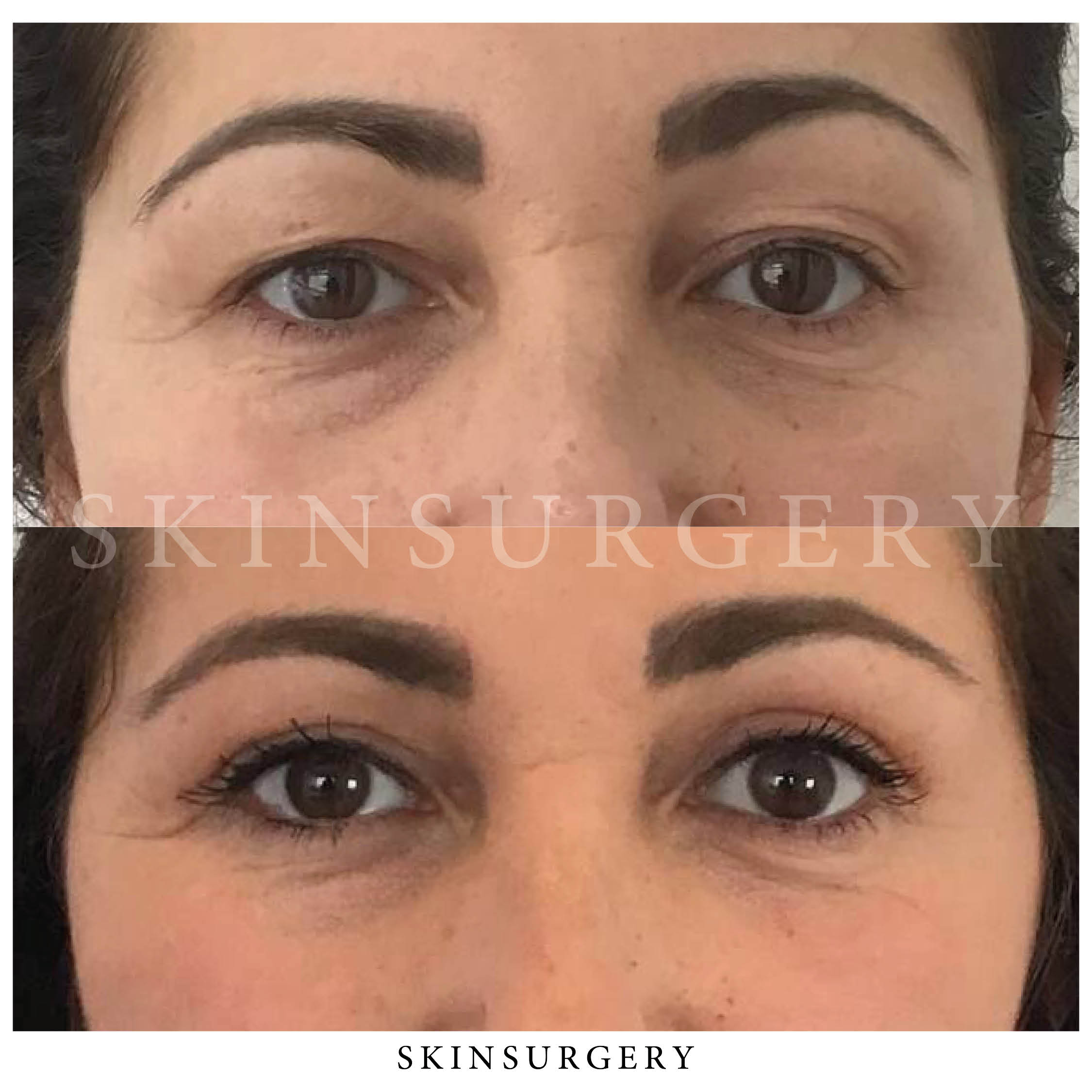 upper eyelid surgery outcome