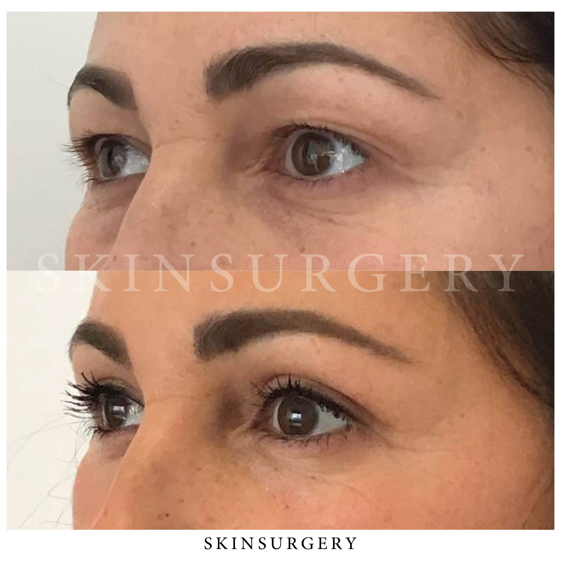 upper eyelid correction end effect