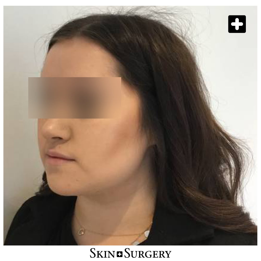 after buccal fat removal