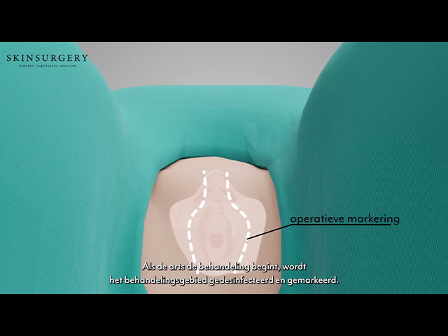 labia correction illustrative video