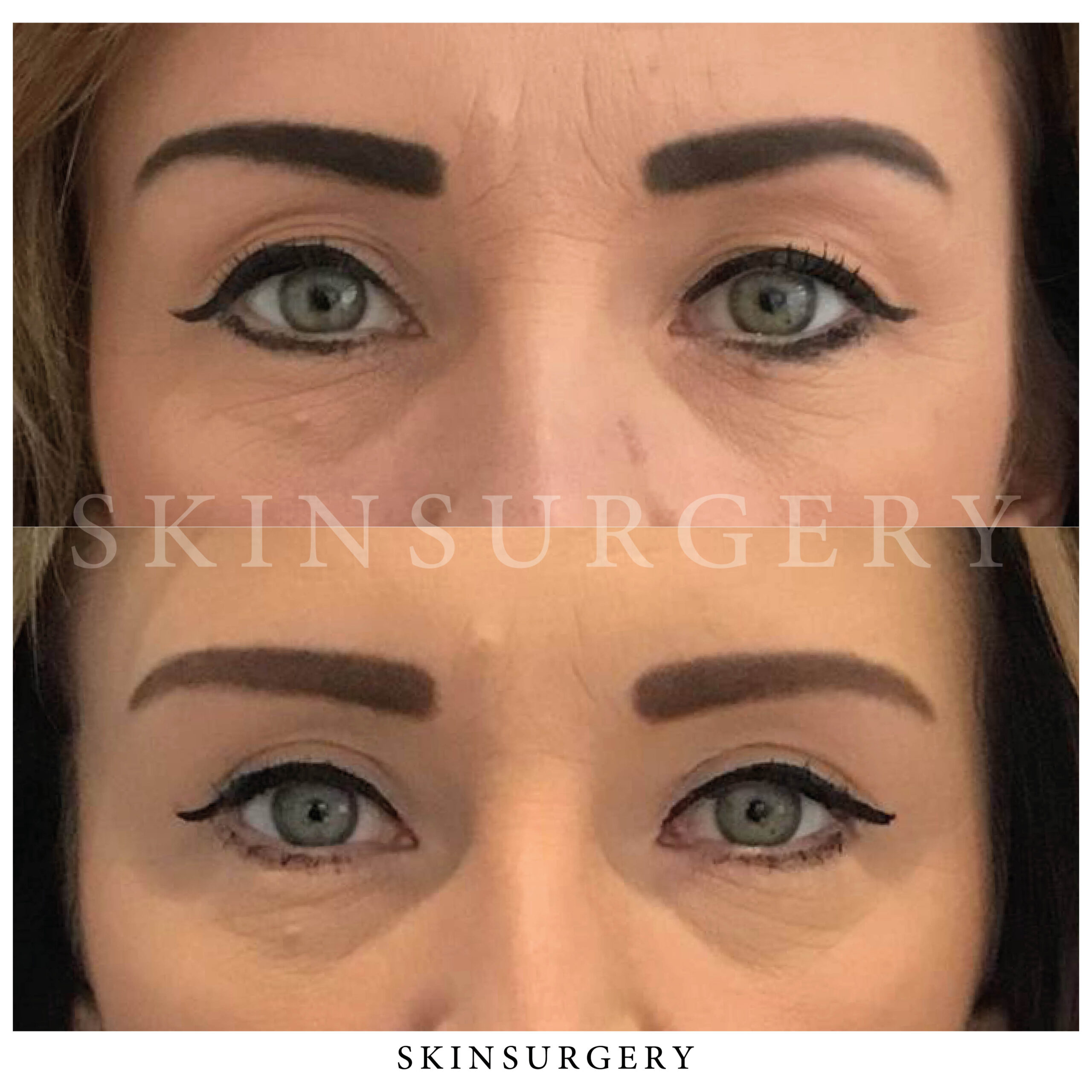 upper eyelid surgery suzanne van soest