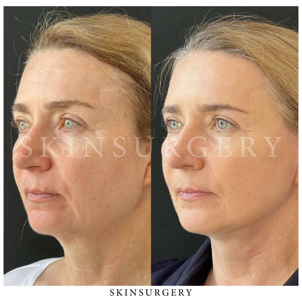facelift treatment