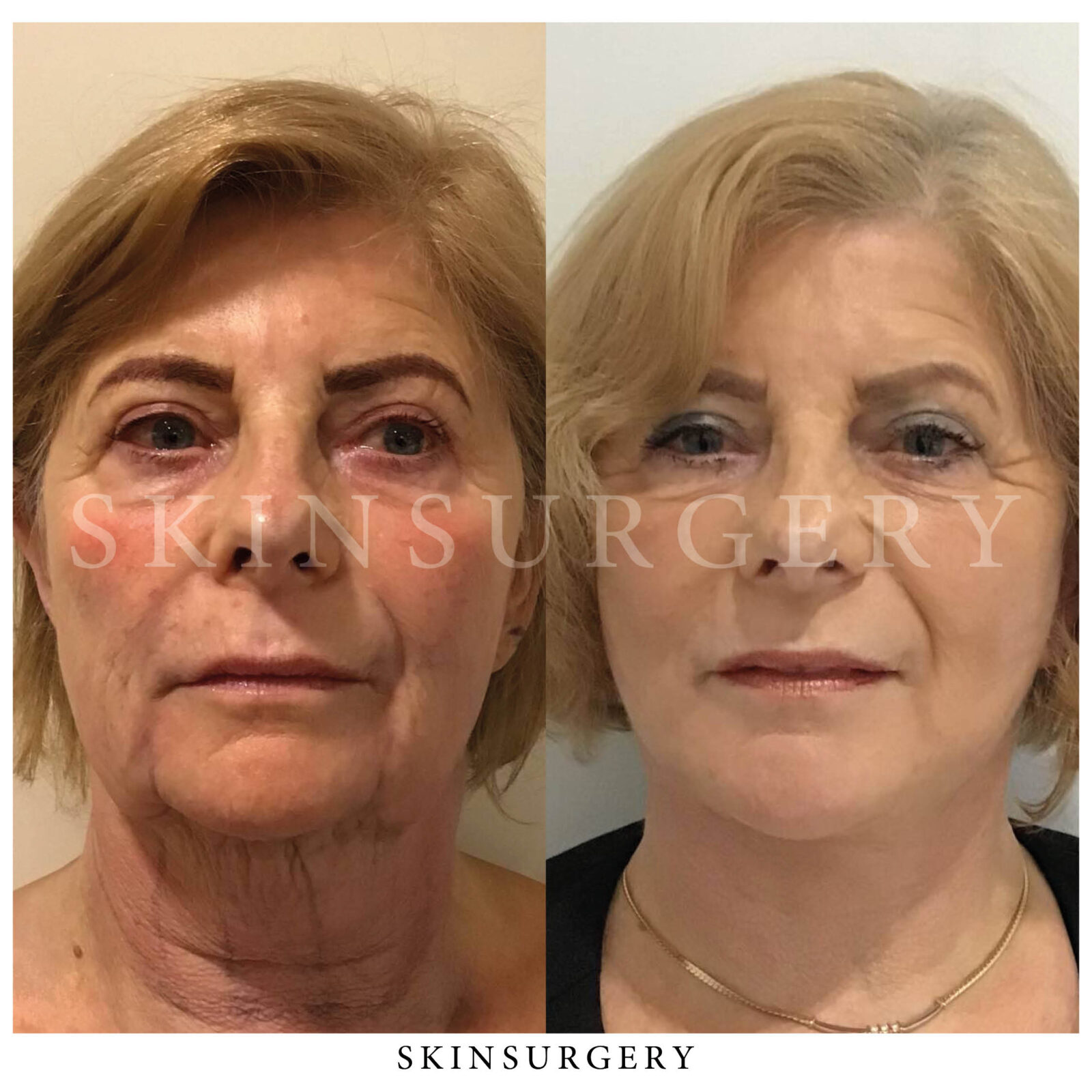 Facelift treatment