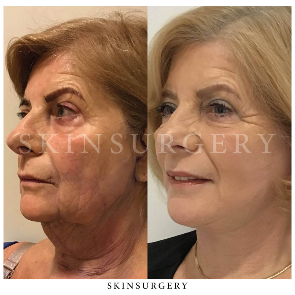 Facelift treatment