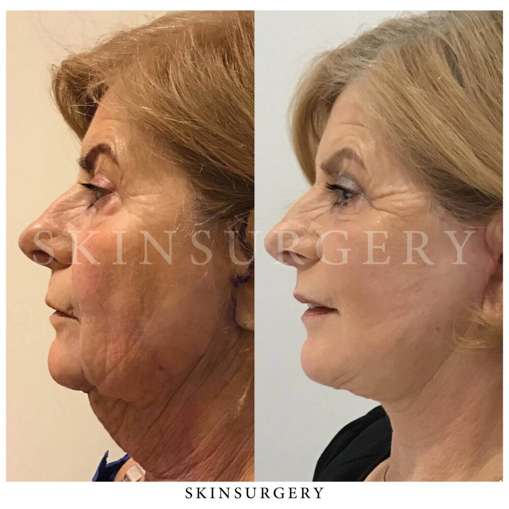 Facelift treatment