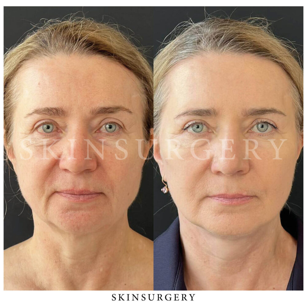 Facelift treatment