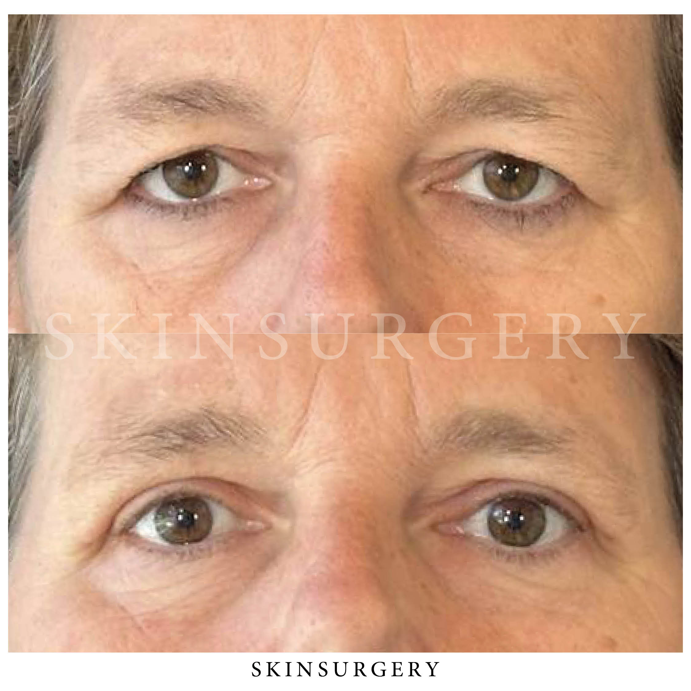 upper eyelid surgery