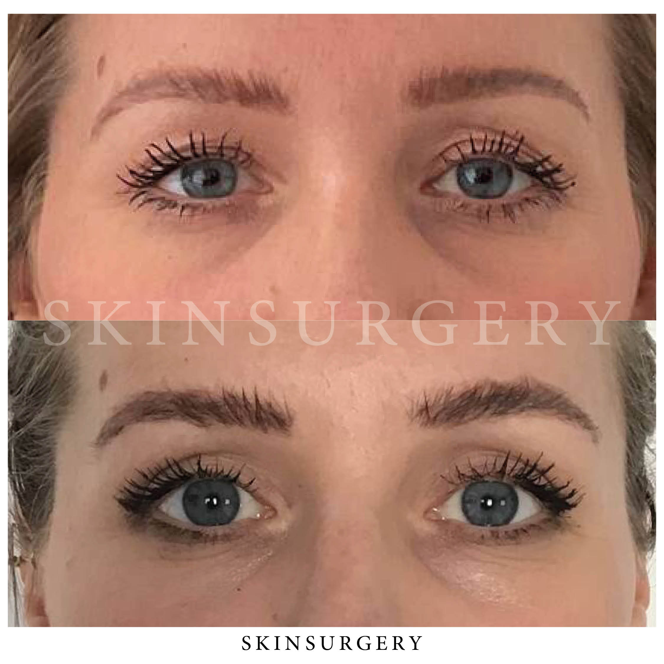 eyelid surgery SkinSurgery Clinic