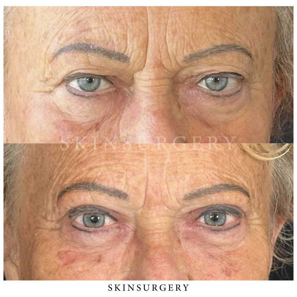 Upper eyelid surgery before and after skinsurgery clinics e1738711598150