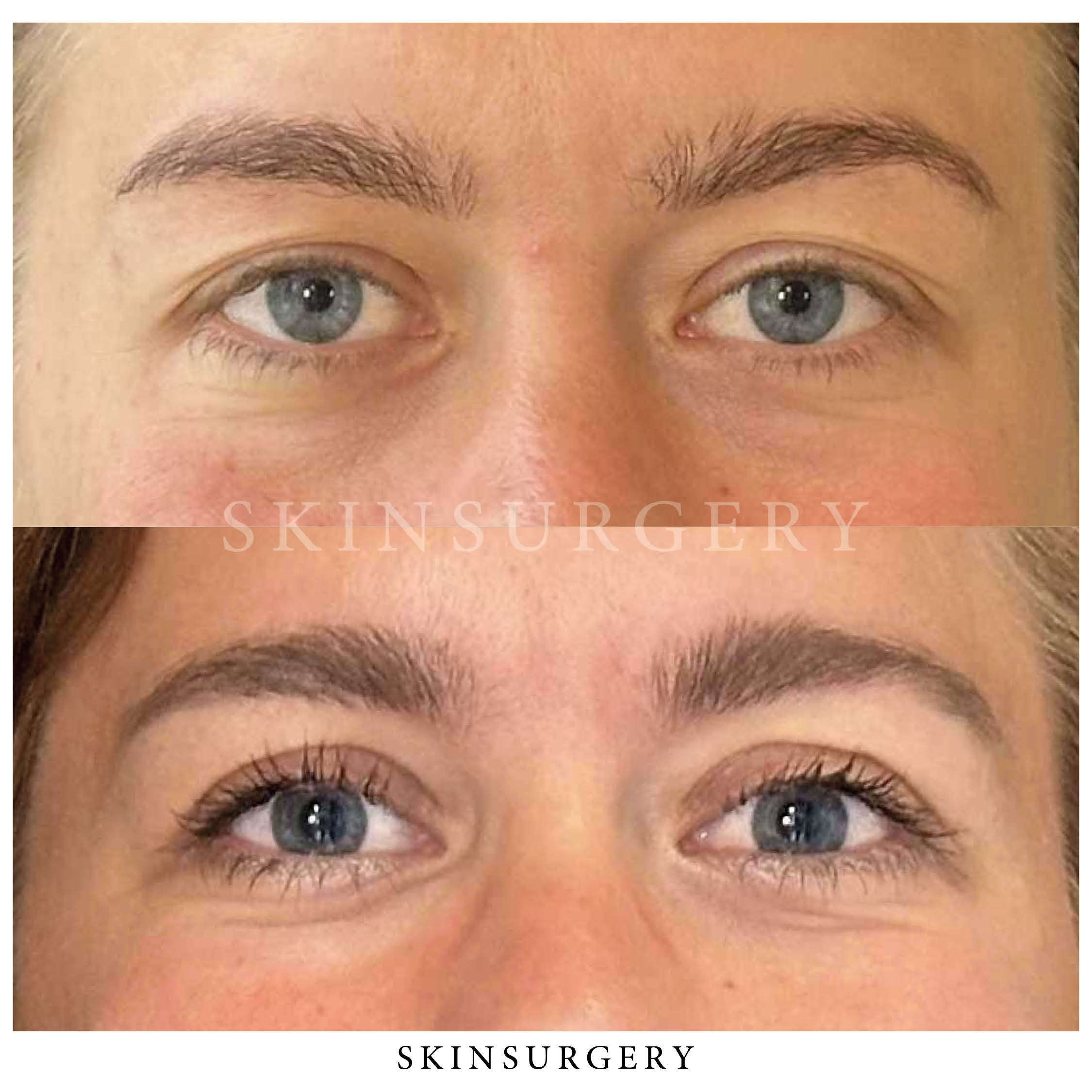 Upper eyelid surgery what age