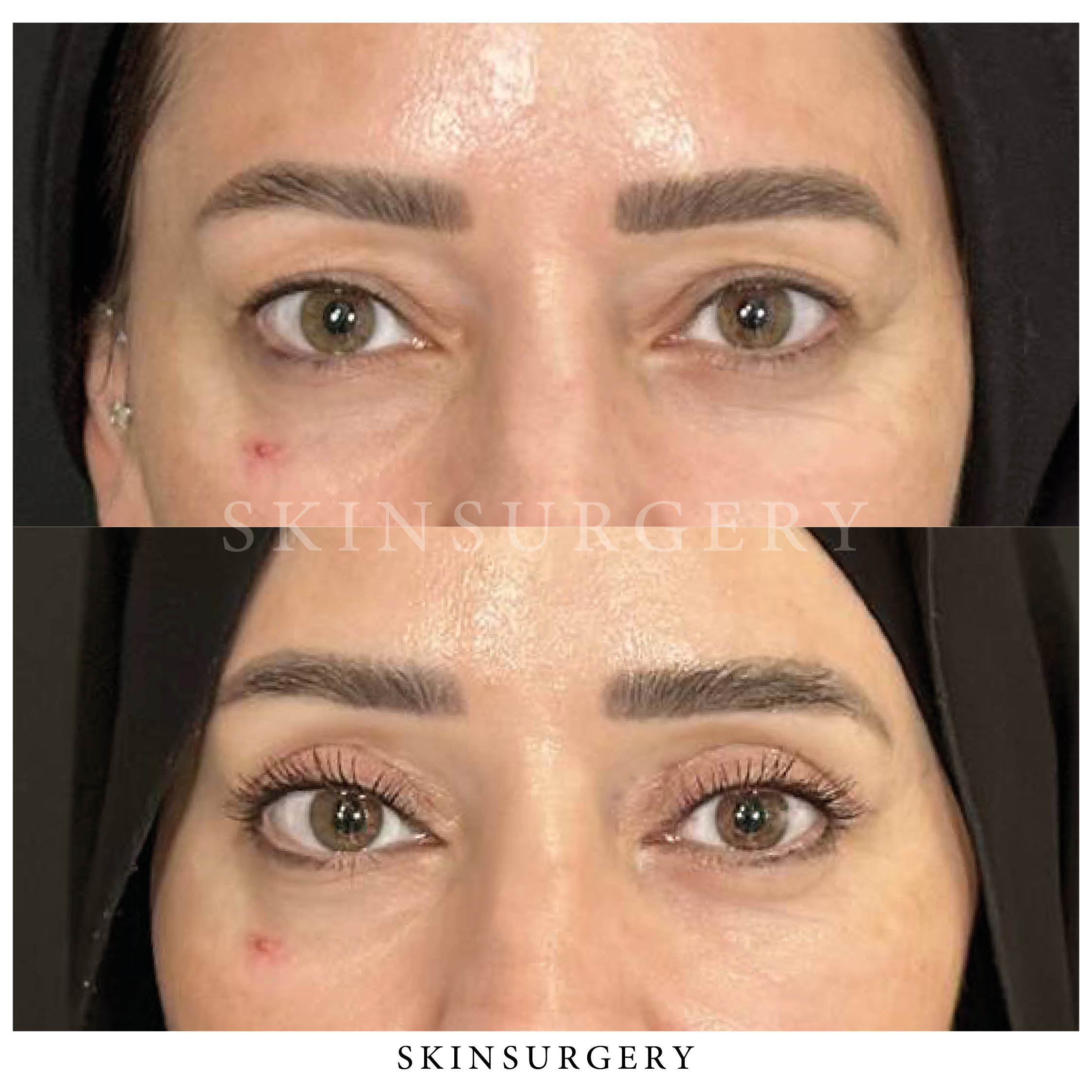 Upper eyelid surgery SkinSurgery Clinics
