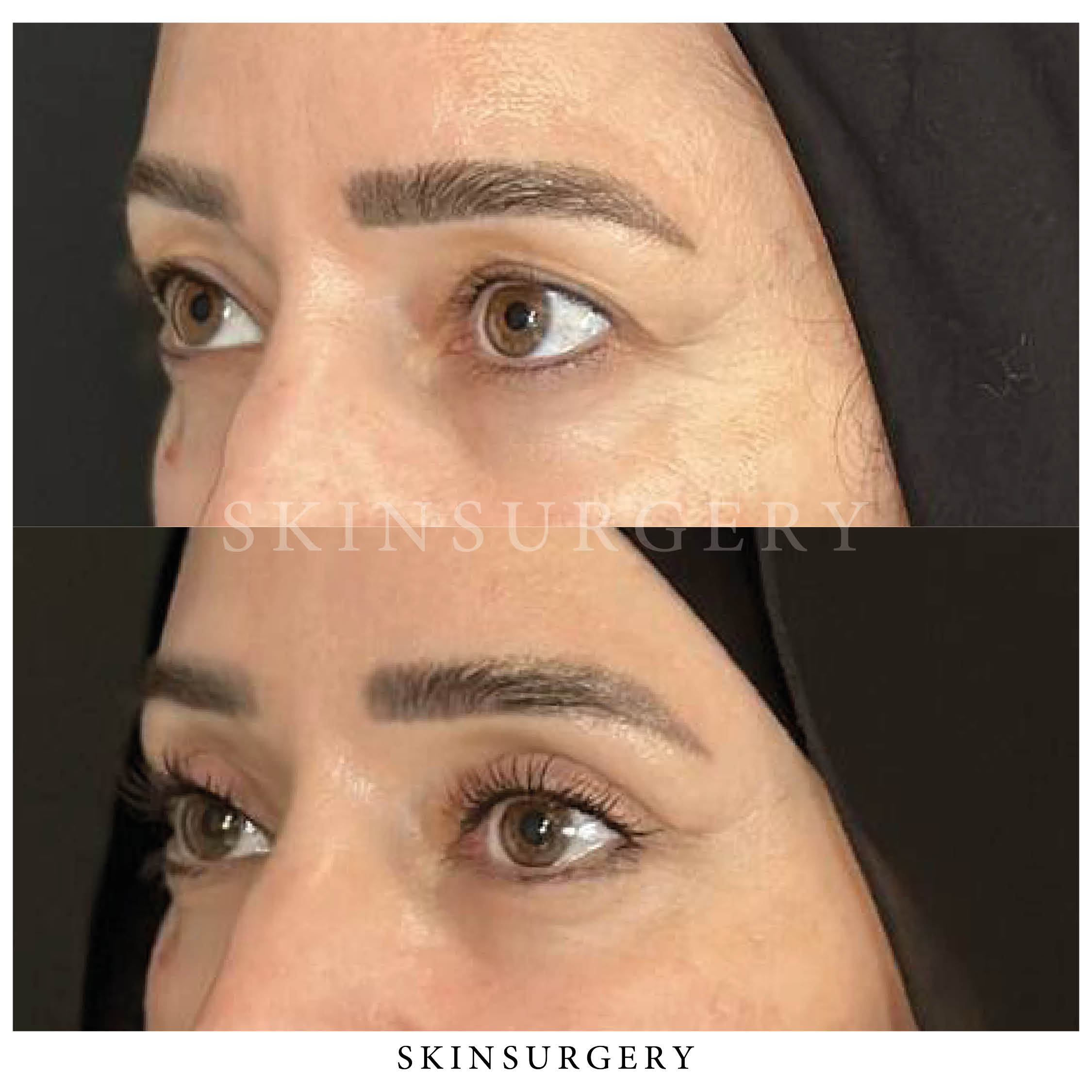 Upper eyelid surgery recovery