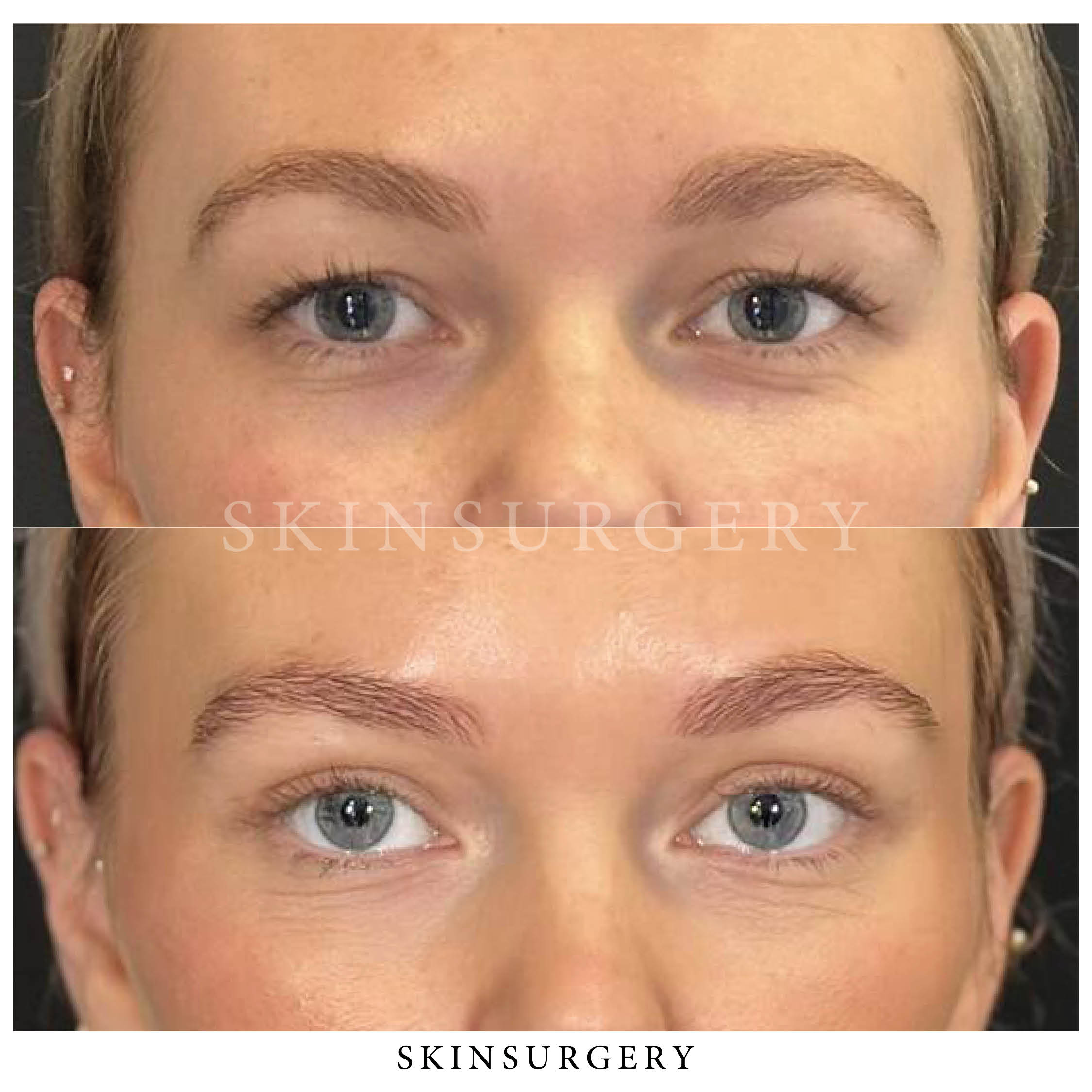 Before after eyelid surgery skinsurgery clinics3