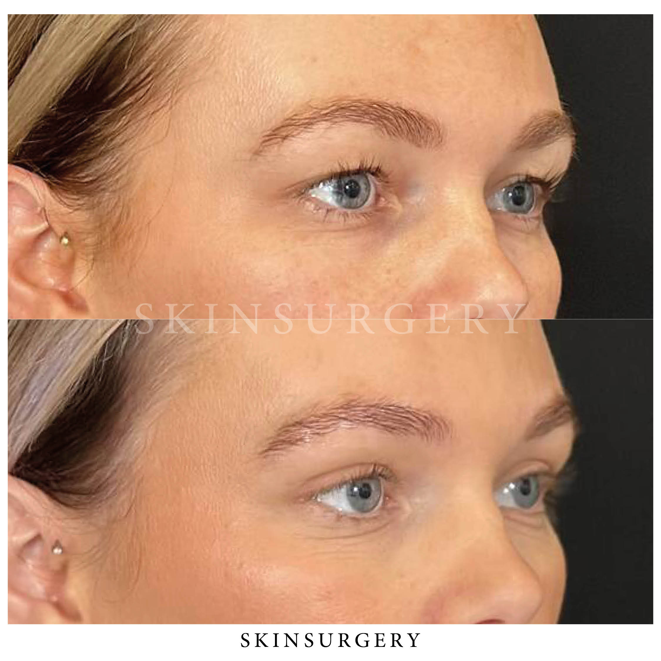 Voor na ooglidcorrectie skinsurgery clinics4 1