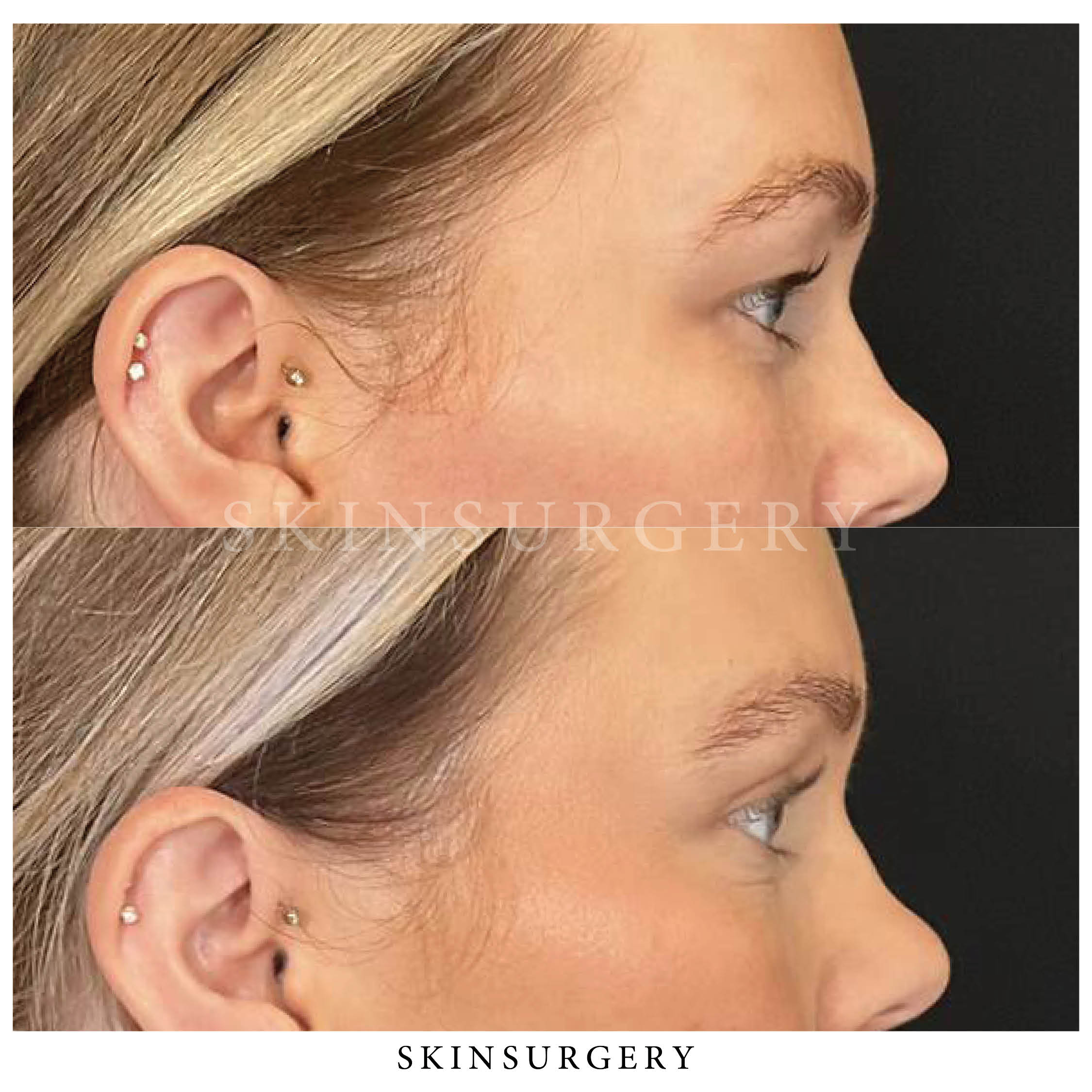 Voor na ooglidcorrectie skinsurgery clinics5 1