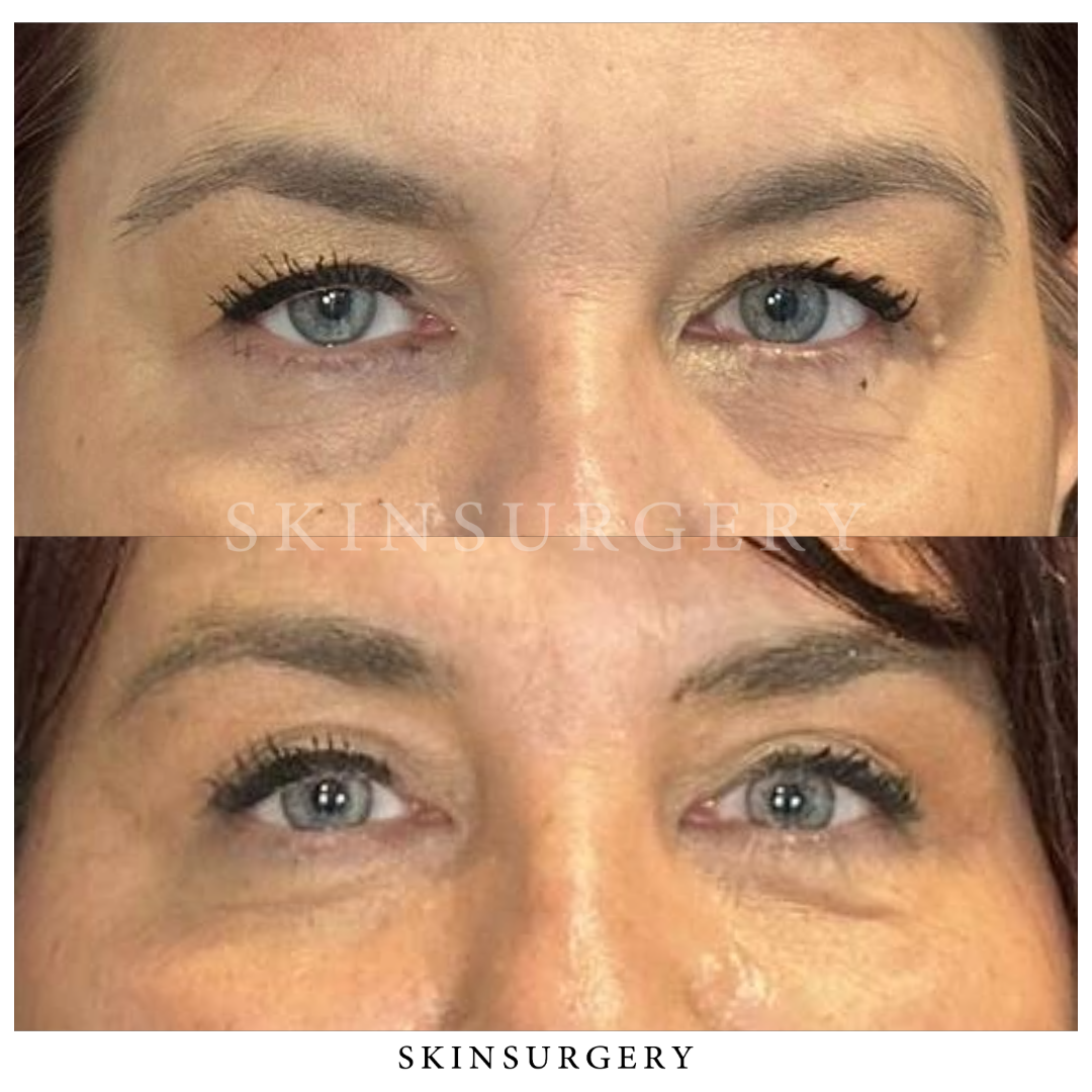 Before after eyelid surgery skinsurgery clinics6