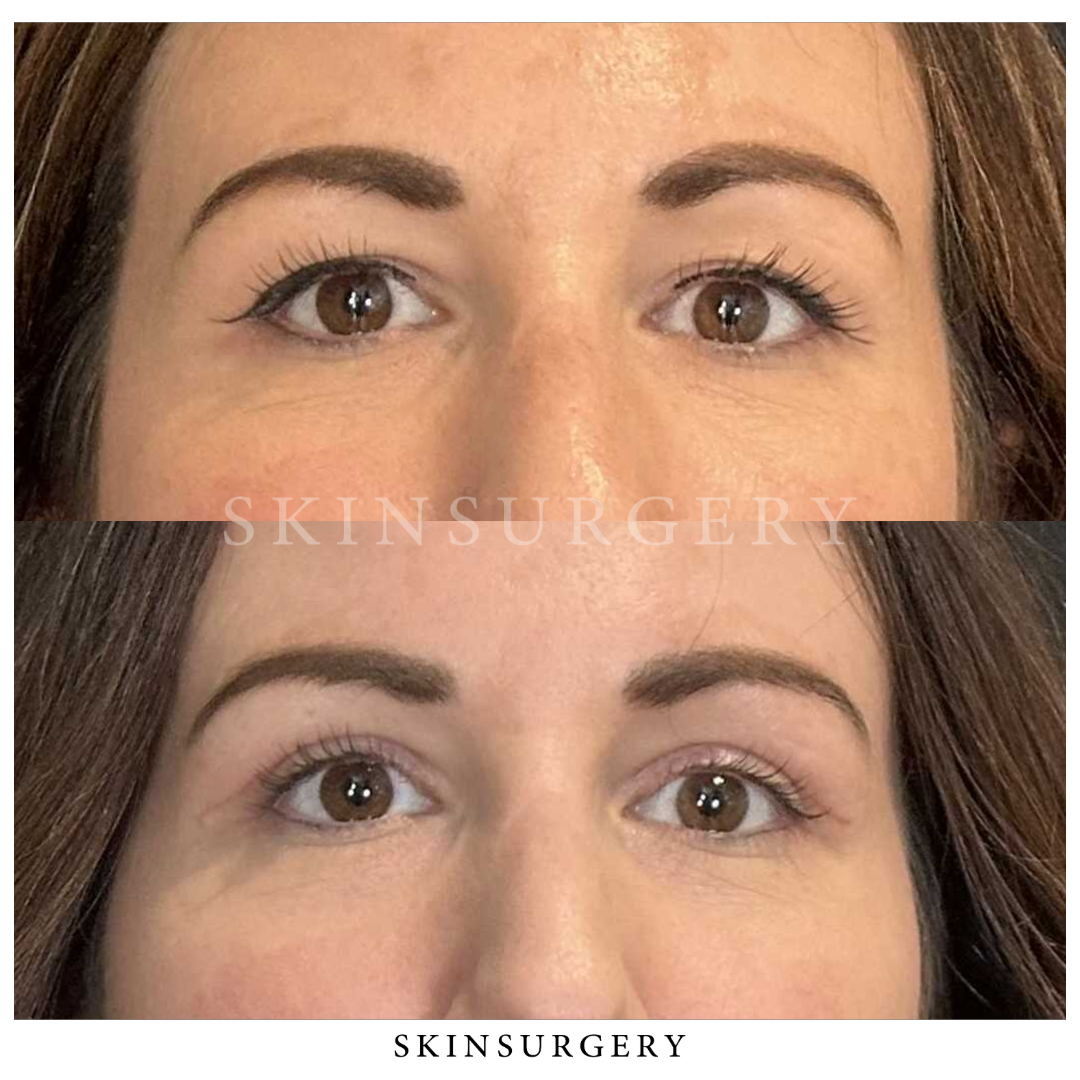 Before after eyelid surgery skinsurgery clinics7