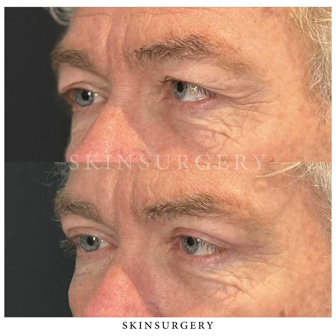 Before after eyelid surgery skinsurgery clinics8