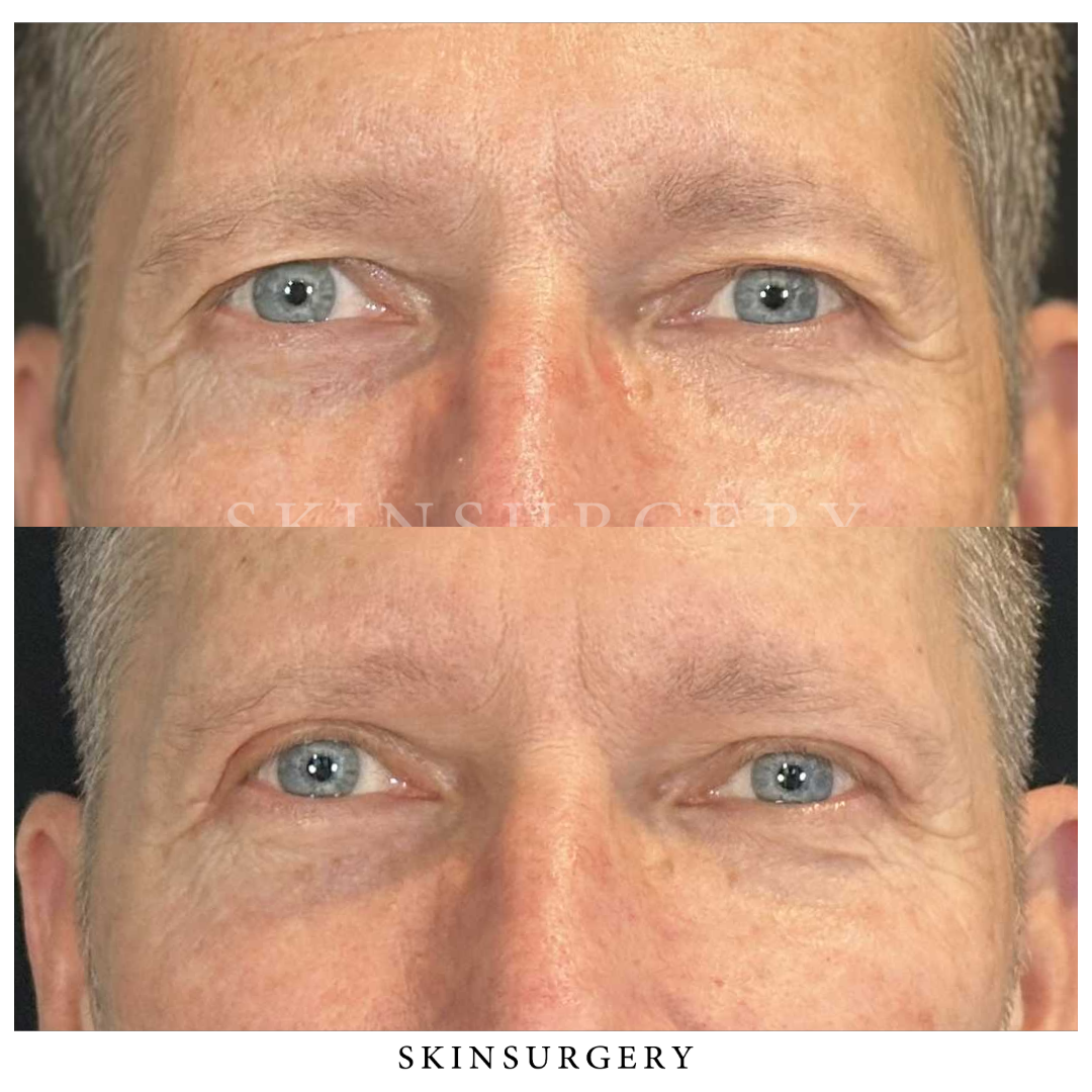 Before after eyelid surgery skinsurgery clinics9